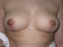 after breast reduction